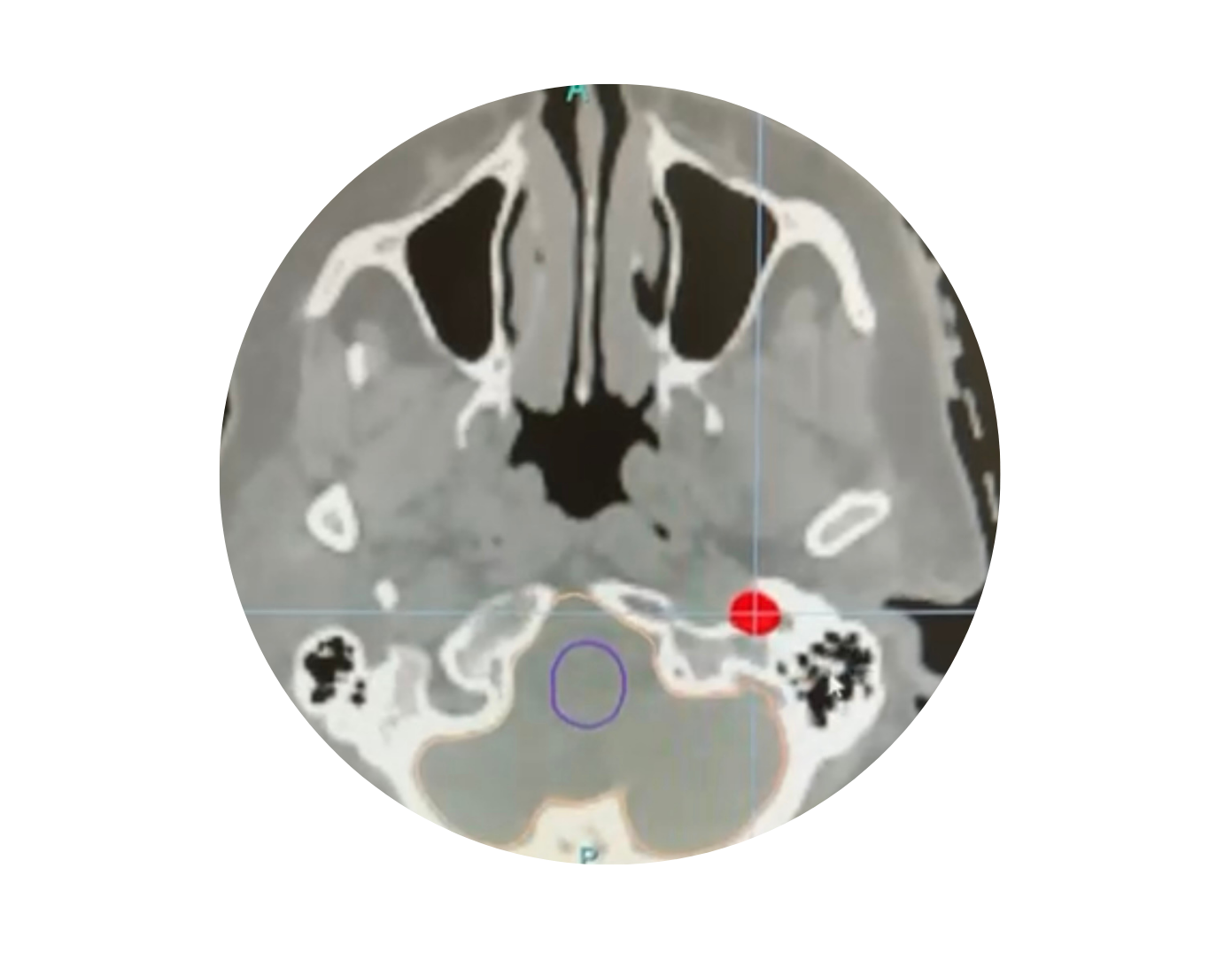 oncología, radioterapia, radioneurocirugía, radioterapia